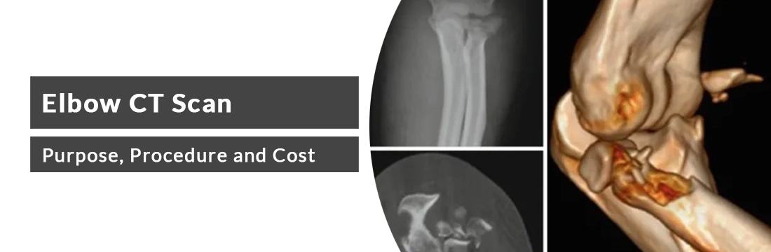 Elbow CT Scan: Purpose, Procedure and Cost in Delhi